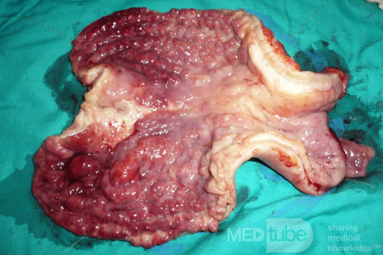 Endoscopy of Scirrhous Gastric Carcinoma involving the entire Fundus, Body and the Antrum (34 of 47)