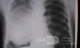 Bronchogenic carcinoma 