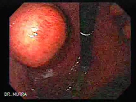 Gastrointestinal Stromal Tumor - GIST (2 of 65)