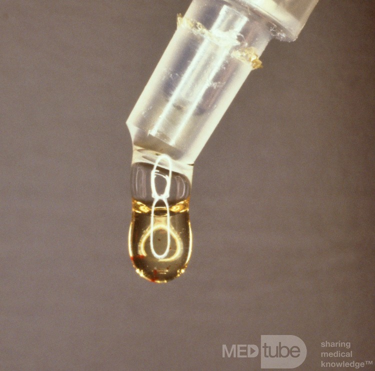 Serous Otitis Media Middle Air Aspirate