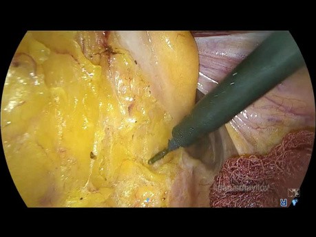 Laparoscopic StomaLess TME, Two-Stage Turnbull-Cutait Pull-Through Coloanal Anastomosis for Supranal Rectal Cancer