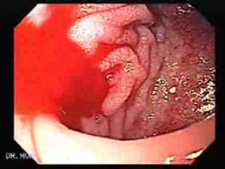 Duodenal Ulcer and Bleeding (16 of 23)