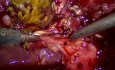 Partial Cholecystectomy