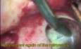 Microsurgery in Endodontics - surgical video