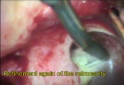 Microsurgery in Endodontics - surgical video