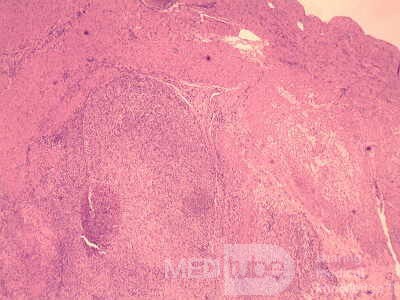 Gastrointestinal Stromal tumor (GIST) (59 of 65)