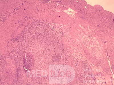 Gastrointestinal Stromal tumor (GIST) (59 of 65)