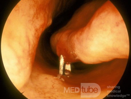 Foreign Body Nasal Cavity of Dental Origin