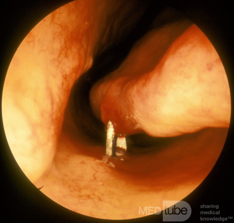 Foreign Body Nasal Cavity of Dental Origin
