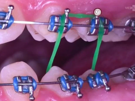 Scissor Bite Correction in Orthodontics by Cross Elastic Band