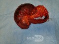 Obstructive Ileus - Right Colon Flexure Cancer
