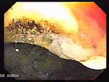 Penetration of Adjustable Laparoscopic Gastric Banding (4 of 4)