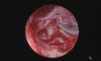 Cholesteatoma Exclusively Ear Endoscopic Surgery
