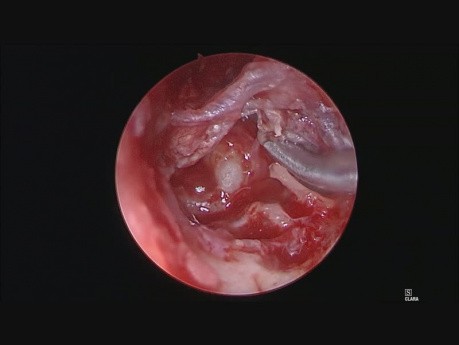 Cholesteatoma Exclusively Ear Endoscopic Surgery