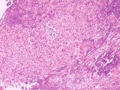 Gastrointestinal Stromal tumor (GIST) (56 of 65)