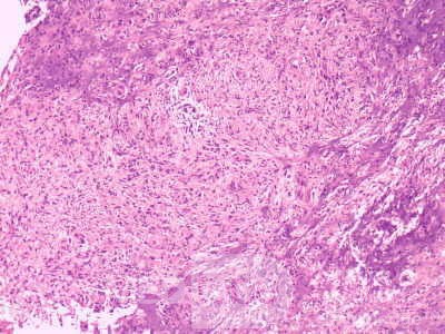 Gastrointestinal Stromal tumor (GIST) (56 of 65)