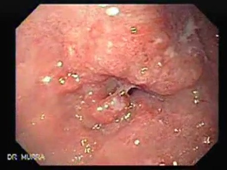 Adenocarcinoma of the middle third (1 of 5 )
