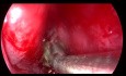 Left Maxillary Sinus Fungal Ball