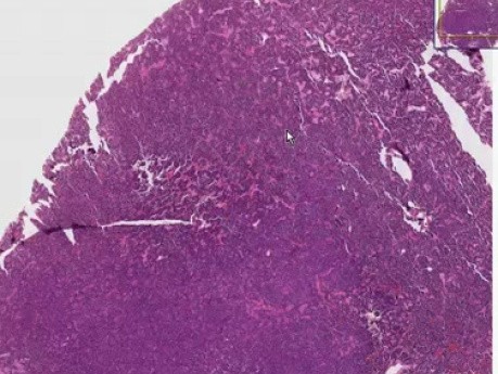 Small cell carcinoma - Histopathology - Lung