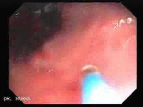 Tubulo - Villous Rectal Adenoma - Endoscopy (34 of 35)