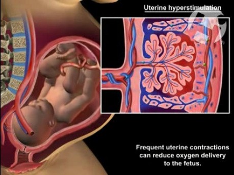 Interruption of Maternal-Fetal Oxygen Delivery