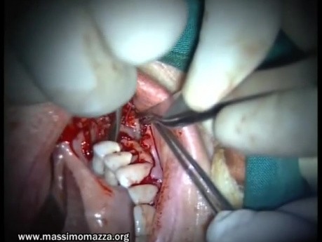 Regeneration Of Multialveolar Process 16-17 (2/4