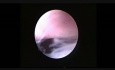 Vagina - Hysteroscopy