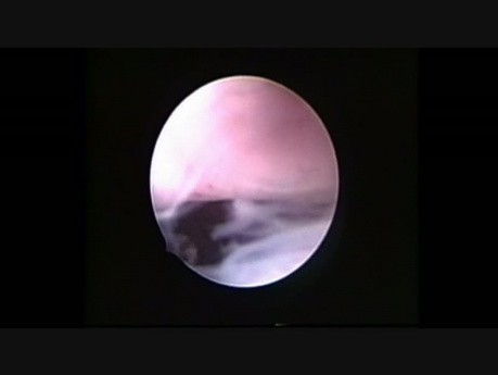 Vagina - Hysteroscopy