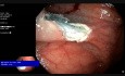 Piece-meal EMR in Cecum