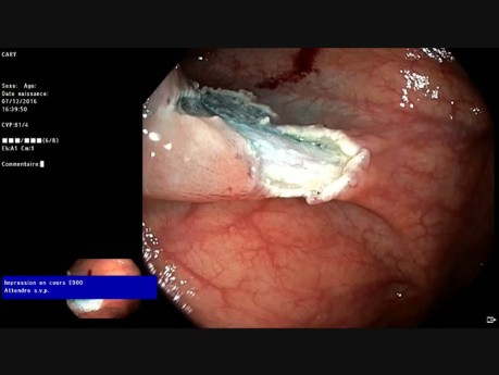 Piece-meal EMR in Cecum