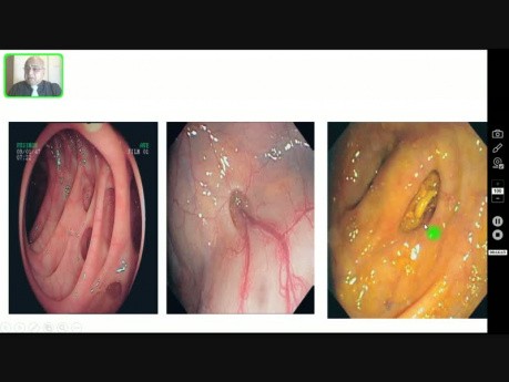 Colonoscopy - a Pictorial Overview