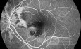 Choroidal Neovascularisation in a Patient with Angioid Atreaks (Fluorescein Angiography)