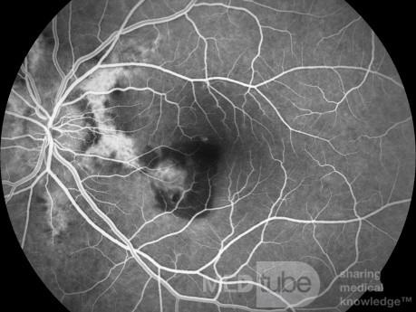 Choroidal Neovascularisation in a Patient with Angioid Atreaks (Fluorescein Angiography)