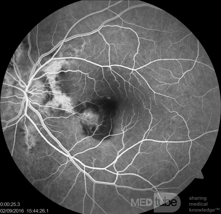 Choroidal Neovascularisation in a Patient with Angioid Atreaks (Fluorescein Angiography)