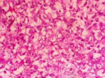 Metastasis of Renal Carcinoma to the ascending colon (9 of 11)