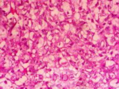 Metastasis of Renal Carcinoma to the ascending colon (9 of 11)