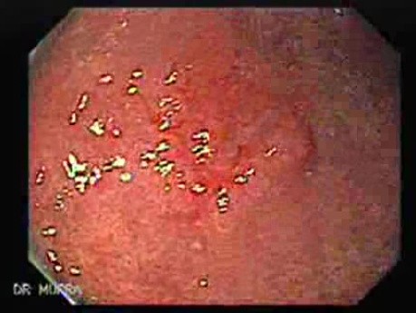 Early Gastric Adenocarcinoma - Endoscopy (2 of 5)