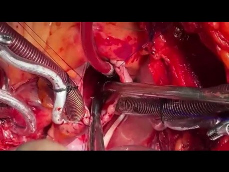 Patient with Previous Amplatzer Closure if ASD and VSD and RV Failure 