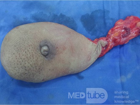 Breast Cancer