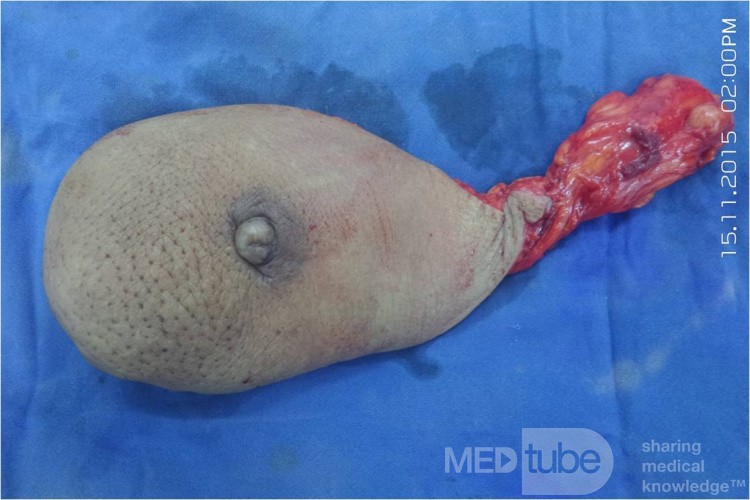 Breast Cancer