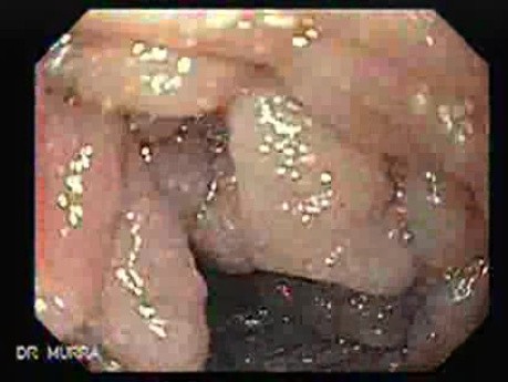 Ovarian Carcinoma with Gastric and Duodenal Metastases - Second Part of the Duodenum 