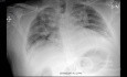 Coronavirus Chest X-Ray (2)