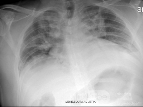 Coronavirus Chest X-Ray (2)