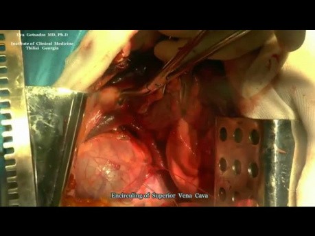 Surgery for the Tumor of Posterior Mediastinum
