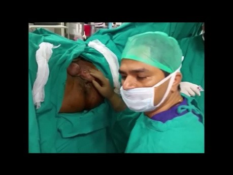 Healed Ano Scrotal Fistula Treatment