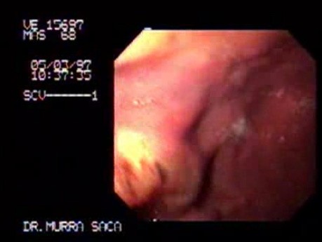 Linitis Plastica - Endoscopy 2