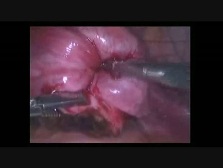 Laparoscopic Correction of Inversion in Non Pregnant Uterus