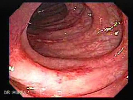 Diverticular Colitis (2 of 7)