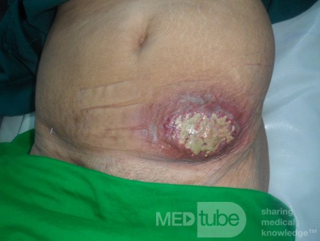 Carbuncle - Anterior Abdominal Wall 