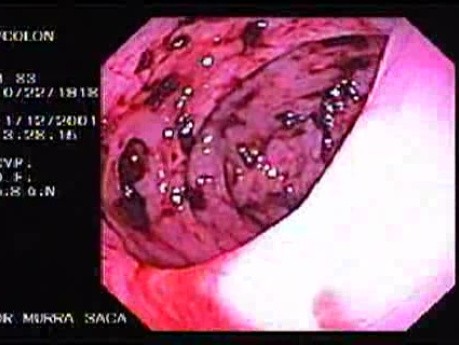Diverticular Disease - Hemorrhage (6 of 15)